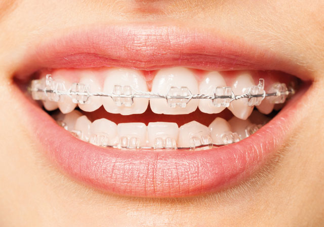 ceramic-braces ceramic-braces